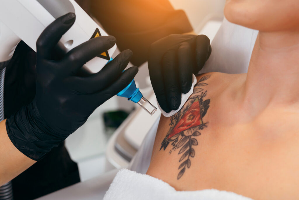 Laser Tattoo Removal in Nottingham